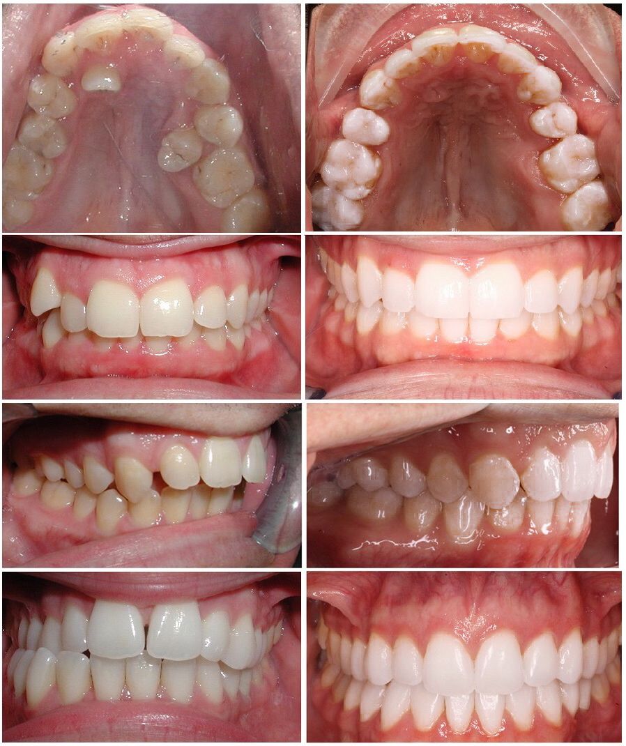 Invisalign before and after