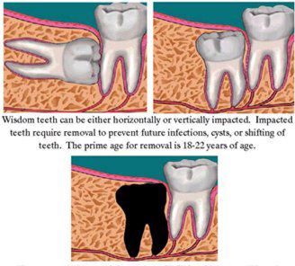 Wisdom Teeth Removal