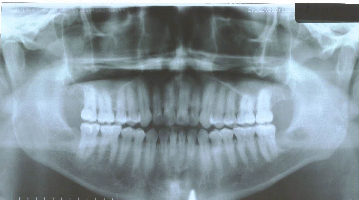 After surgery performed in 2009 with bone graft with PRP (30 years old patient)