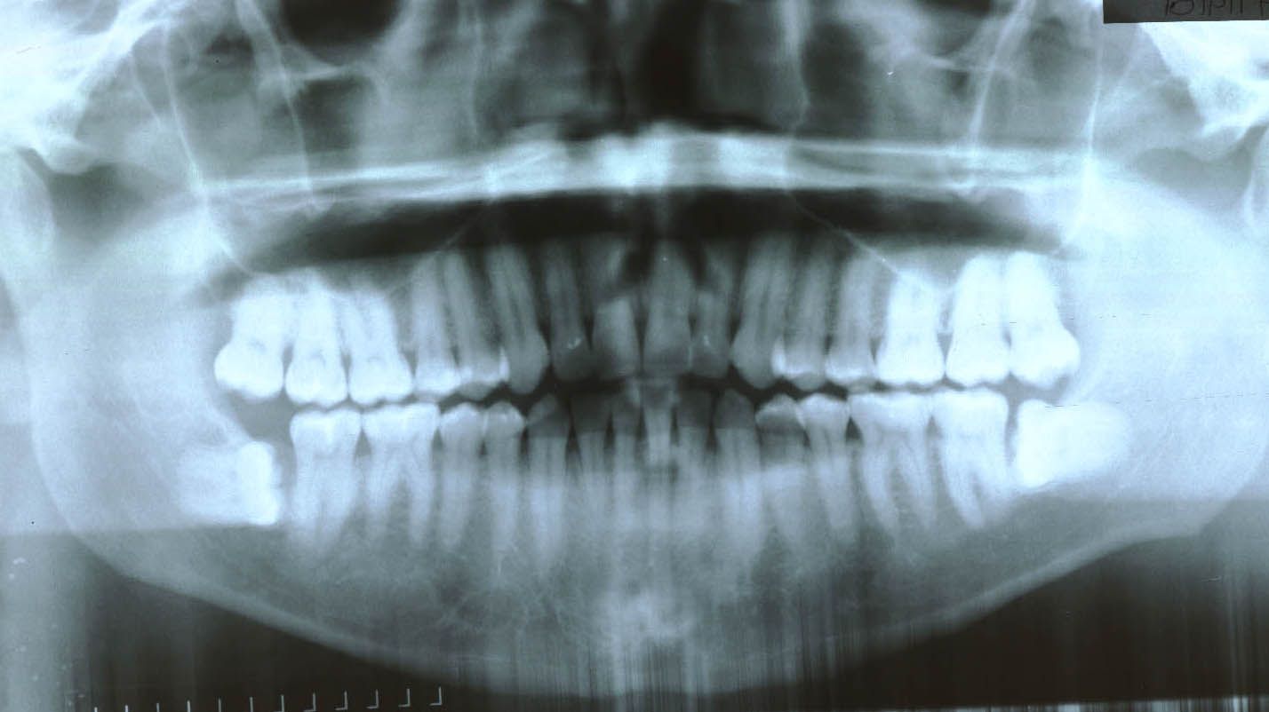 Before surgery performed in 2009 with bone graft with PRP (30 years old patient)