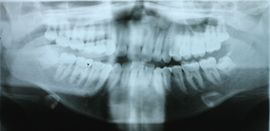 Before surgery with bone graft with PRF (18 years old patient) - 45 minutes procedure