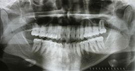 After surgery with bone graft with PRF (18 years old patient) - 45 minutes procedure