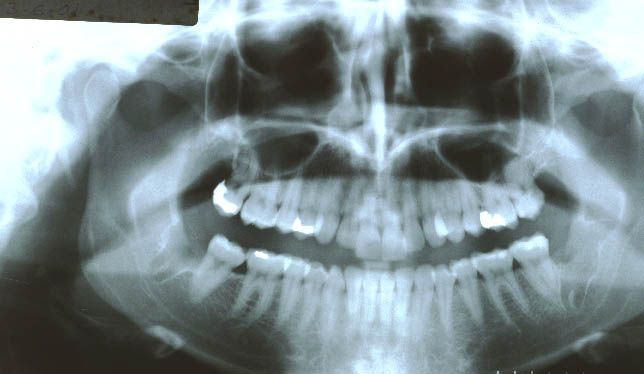 After surgery(3 mos) performed in 2001 with bone graft with PRP (32 years old patient)