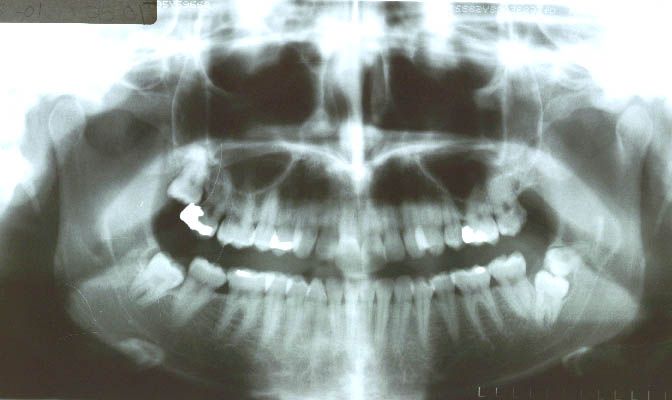 Before surgery(3 mos) performed in 2001 with bone graft with PRP (32 years old patient)