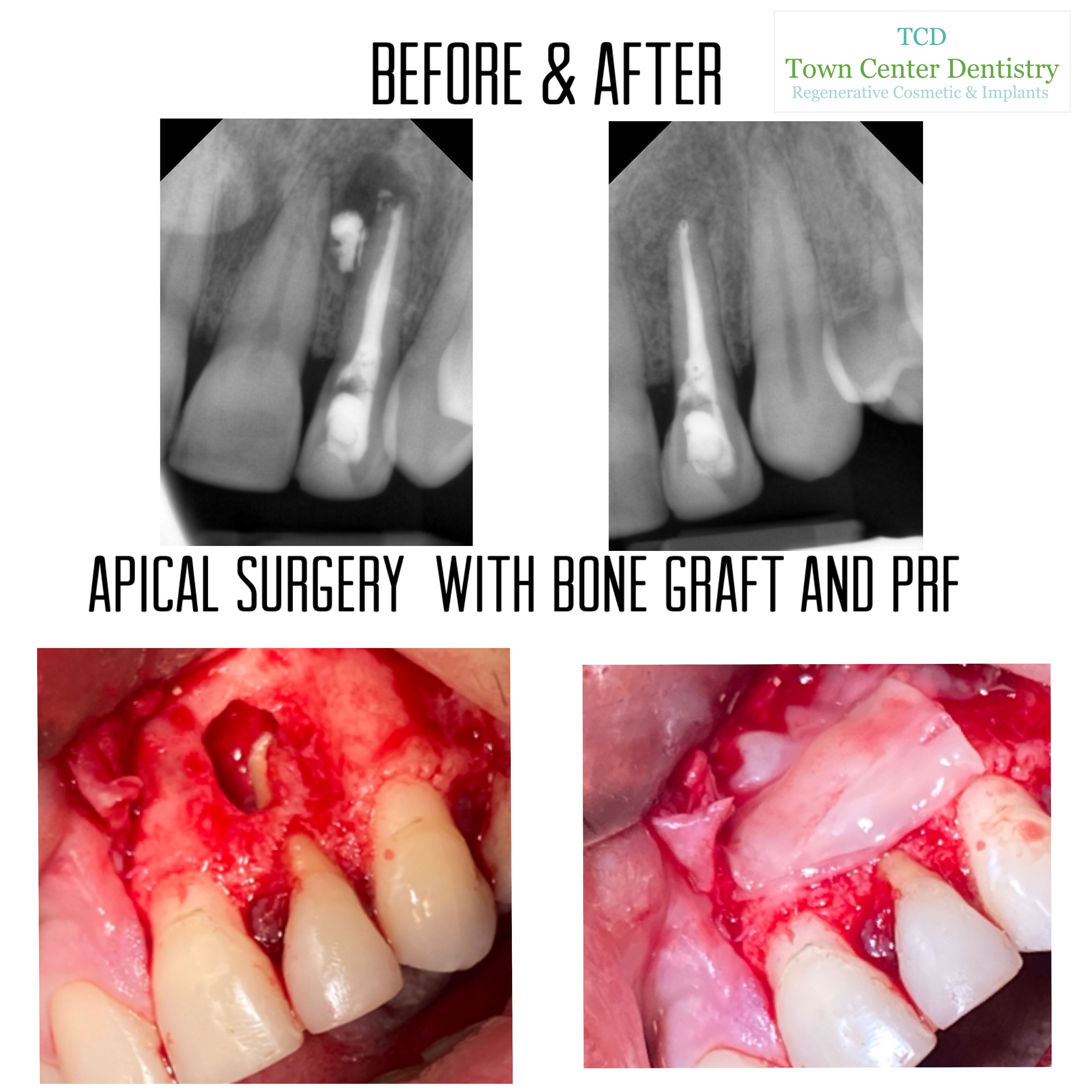 Bone Grafting