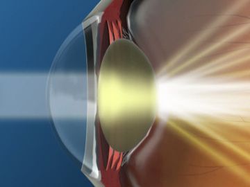 Cataracts: Overview