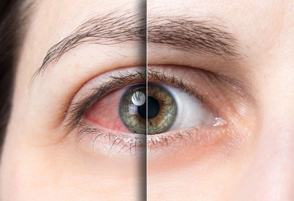 What is Dry Eye and how can it be treated?