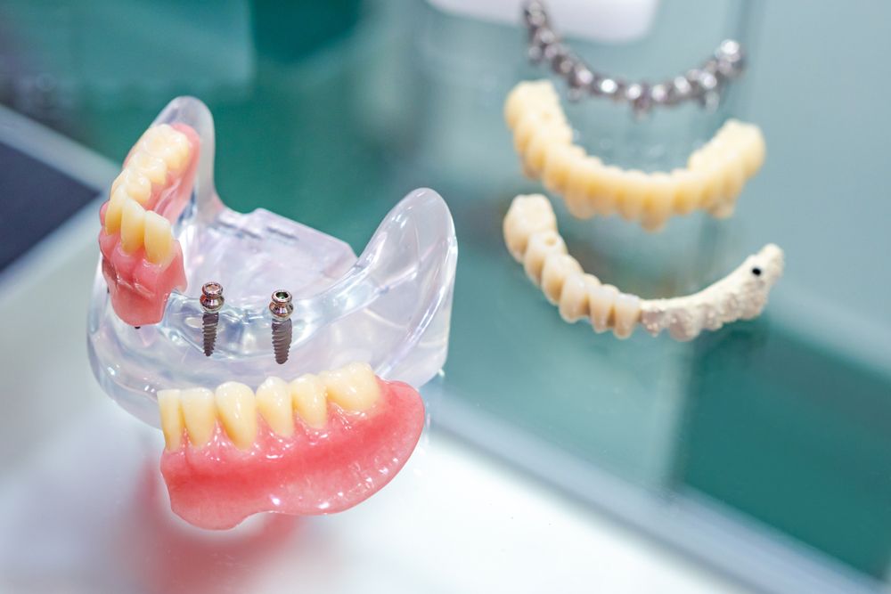 Replacing Missing Teeth: Implant, Bridge, or Removable Denture?