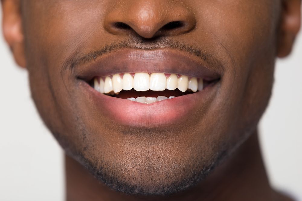 How Permanent Are Veneers?