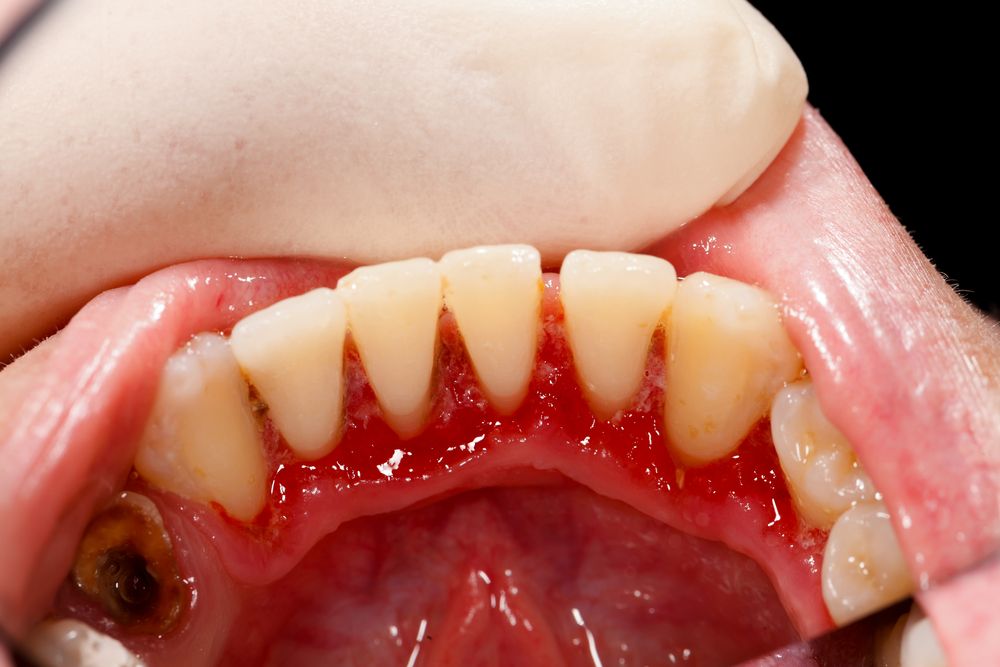 tooth decay