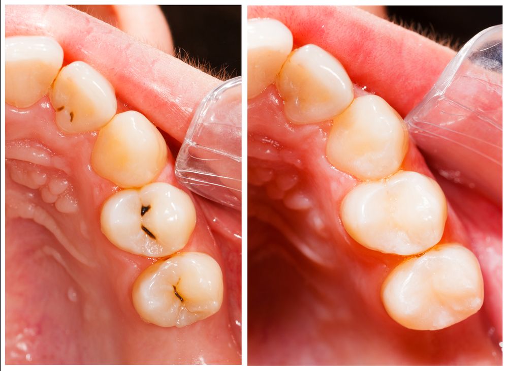 composite fillings