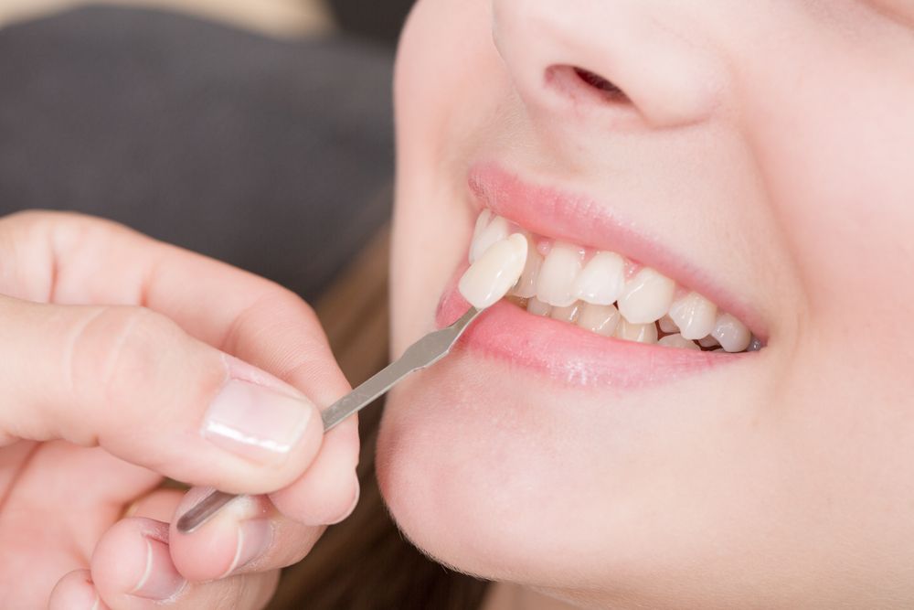 porcelain veneers