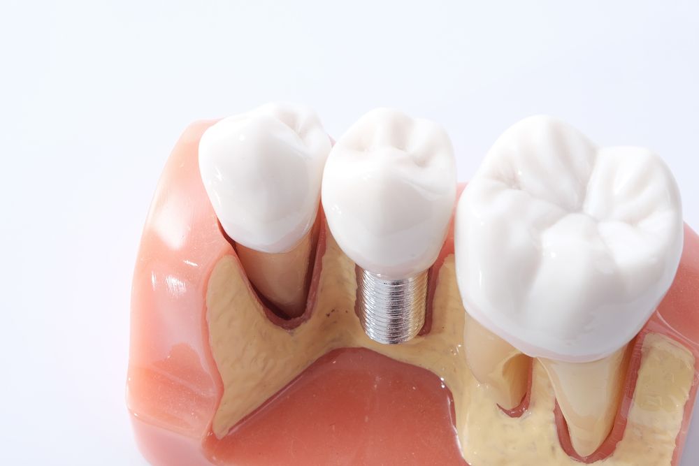 dental implants