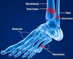Another Downside of NSAID Drug Use: Stress Fractures
