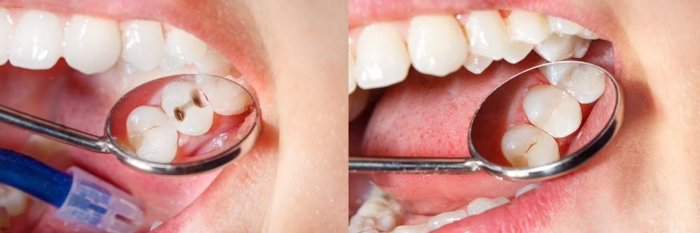 Tooth Decay: Causes and Treatments​​​​​​​