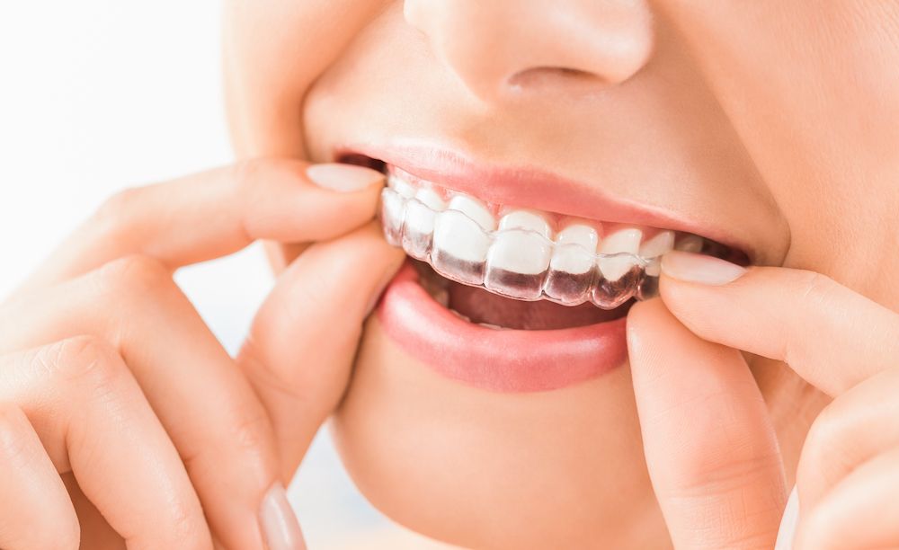 Invisalign 