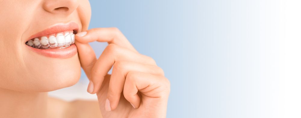 invisalign