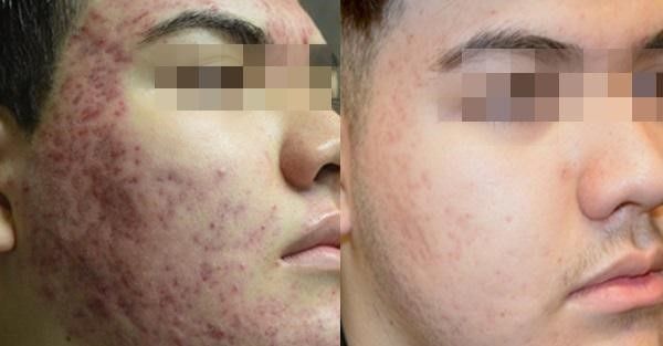 before and after skin treatment