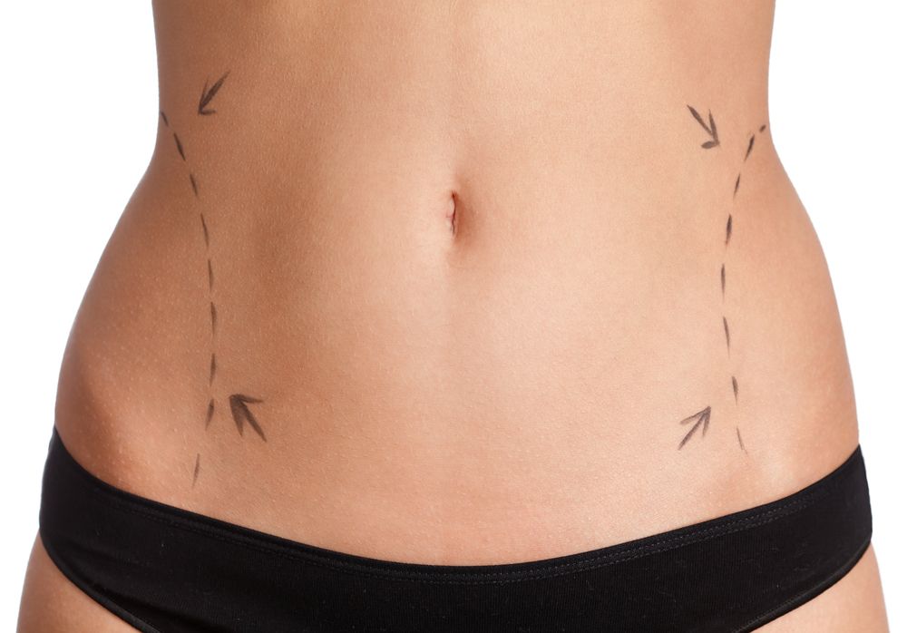 Liposuction Procedure