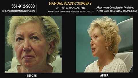 before and after procedure