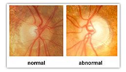 Resolve to Prevent Glaucoma in 2016