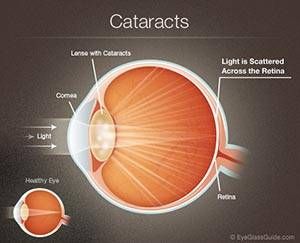 6 Things You Need To Know About Cataracts