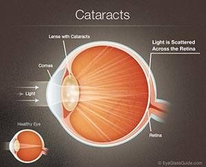 June is Cataract Awareness Month