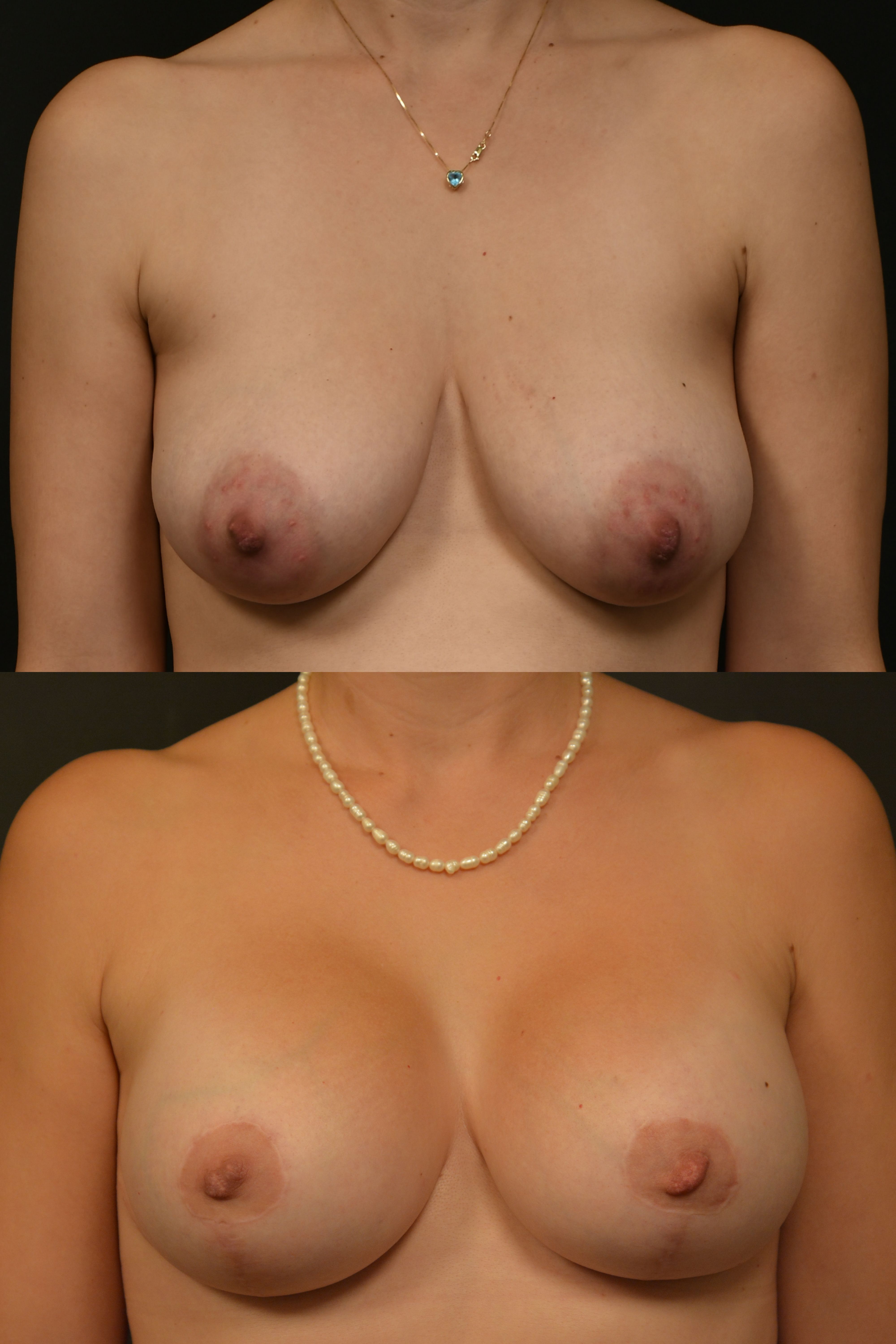 Breast Lift