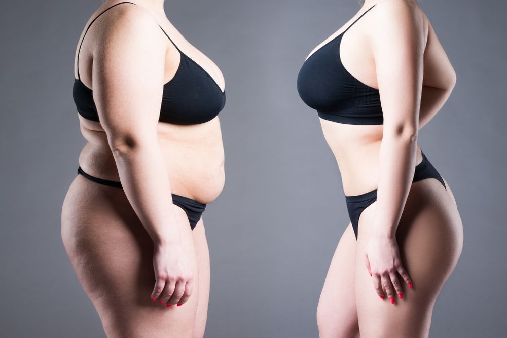Tummy Tuck vs Body Contouring