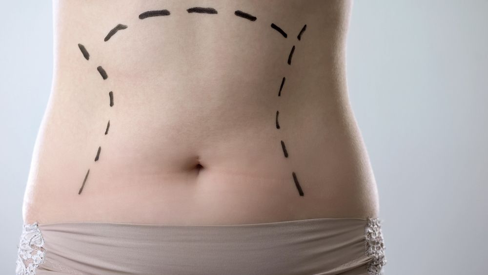 body contouring