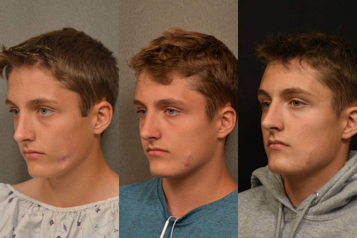 Scar Removal 