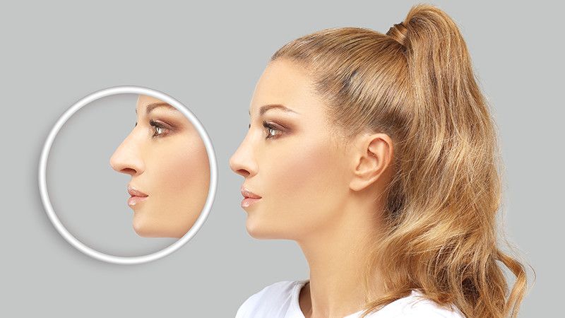 rhinoplasty