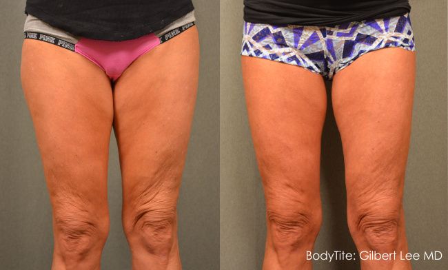 Thigh Lift Scars After 1 Year: Things to Expect - Salameh Plastic