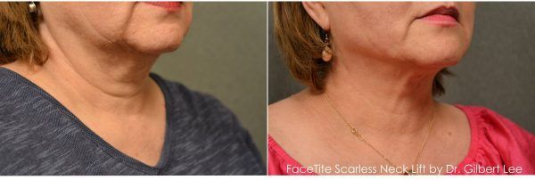 scarless necklift