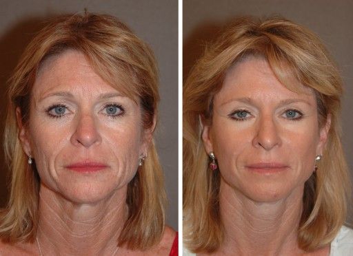 Facelift Before & After Photos: What a Facelift Looks Like at 40, 50, 60 &  70, Facelift in San Diego, CA