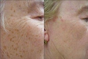 ipl photofacial