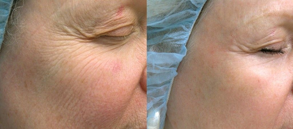 skin resurfacing