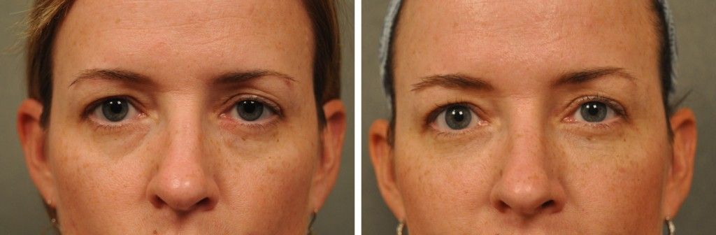 dermal fillers