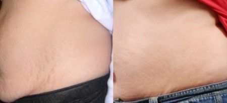 before and after stretch mark removal