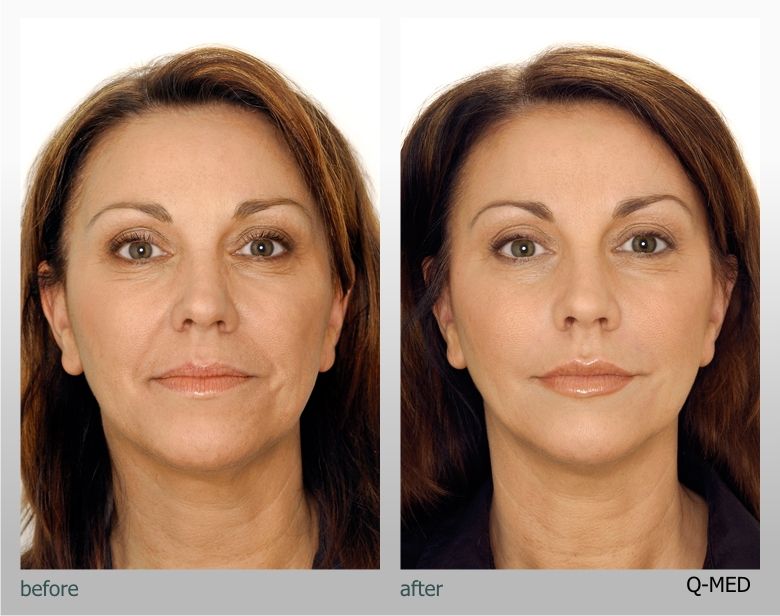 before and after qmed