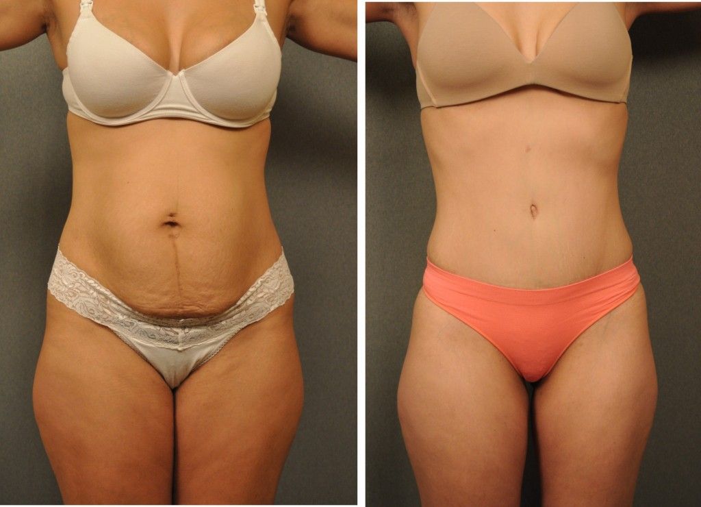 before and after Tummy Tuck Surgery