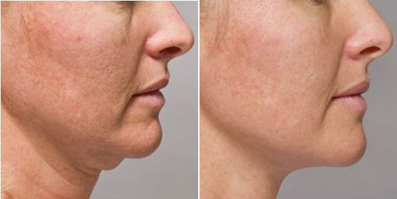 before and after kybella