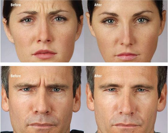 botox & dysport