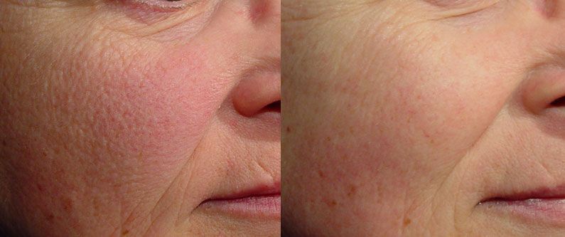 Laser vein removal