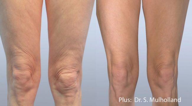 plus legs 002 before and after e1480620575526