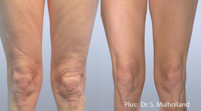 Thigh Lift Scars - How to Reduce Scarring after Thighplasty