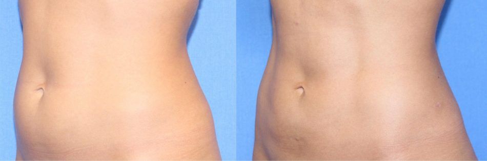 Austin Tummy Tuck