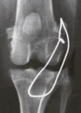 extracapsular repair
