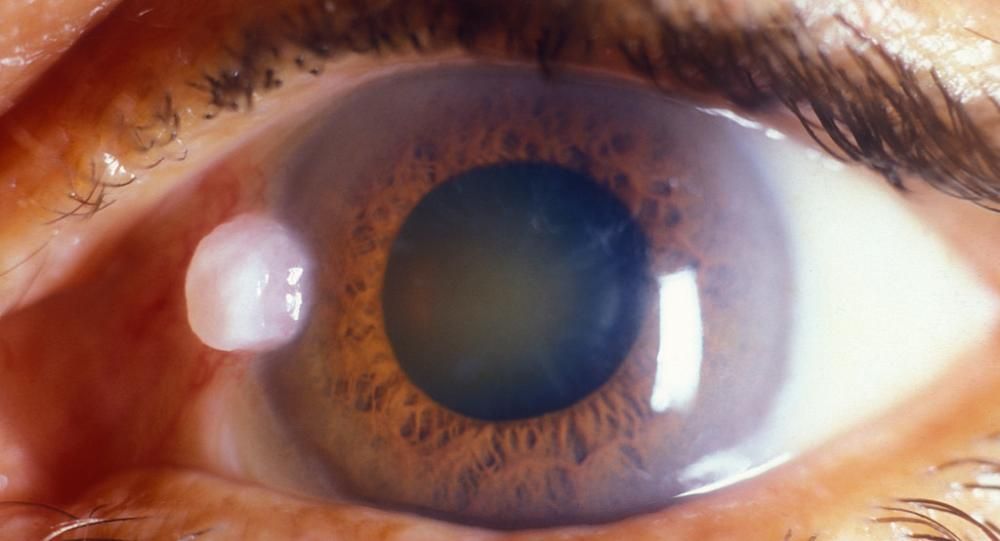 cataract treatment