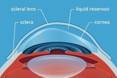 Specialty Contact Lens